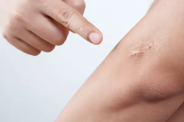 Scars Removal Treatment in Hyderabad