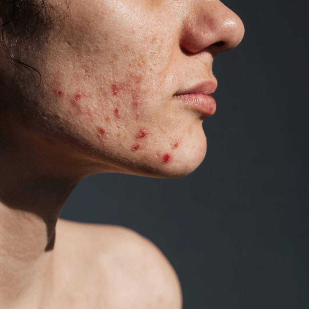 Acne Scarring Prevention