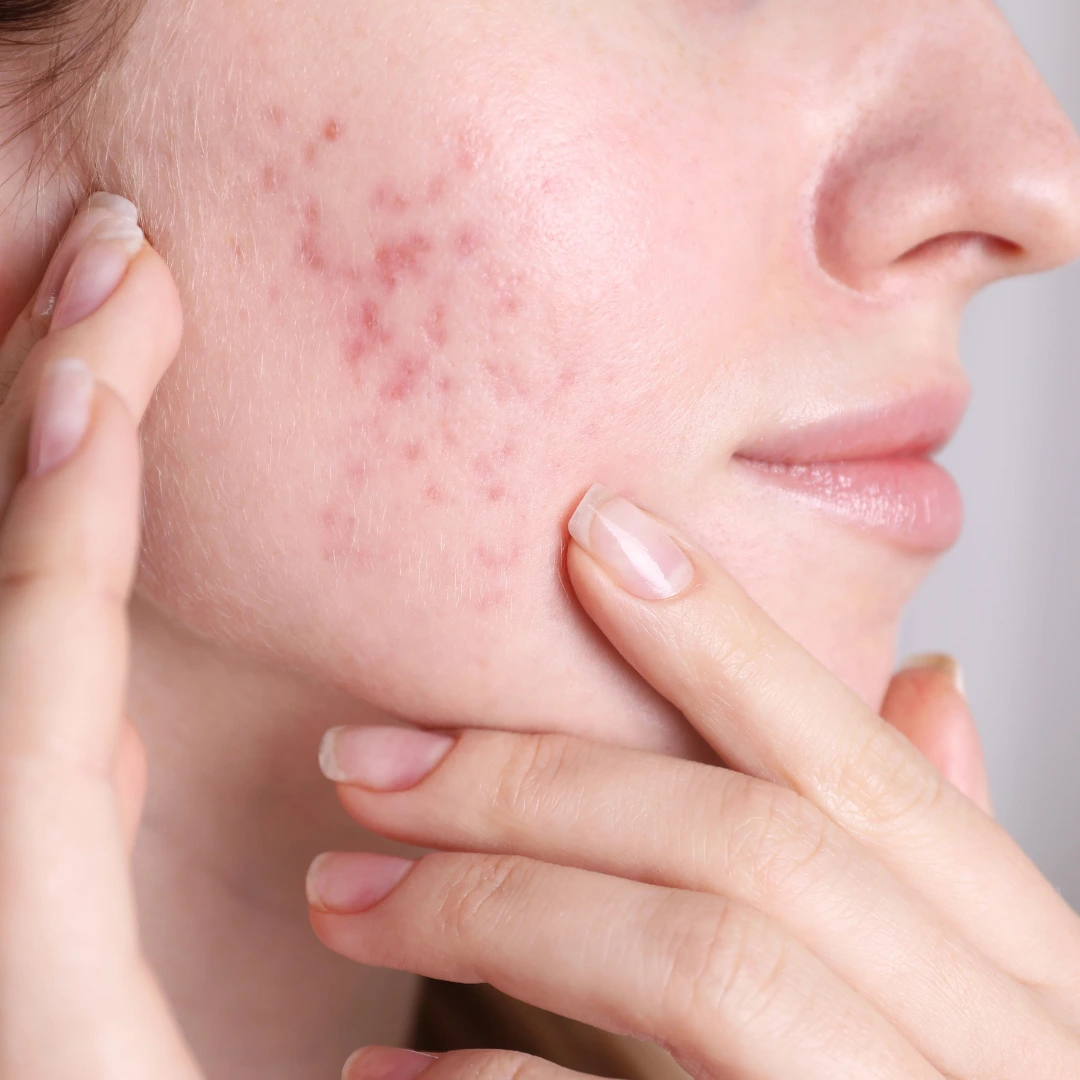 Acne Treatment in Hyderabad