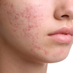 acne scar treatment in hyderabad