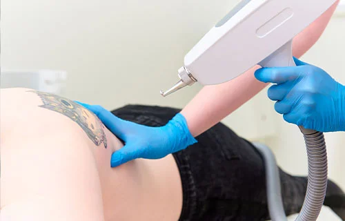 Laser Tattoo Removal Treatment in Hyderabad