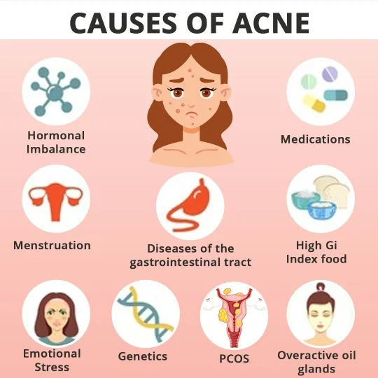 Causes Acne / Pimples: Hormonal Imbalance, Medications, Menstruation, PCOS, Emotional Stress, Overactive Oil Glands and more.