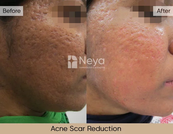 Deep Acne Scar Treatment Results