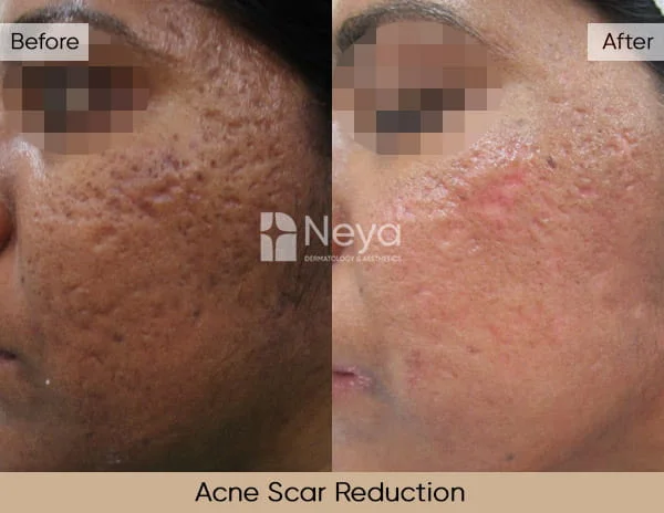 Acne Scar Reduction Before and After