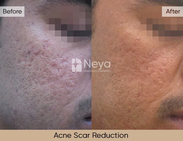 Laser Acne Scar Removal Before and After