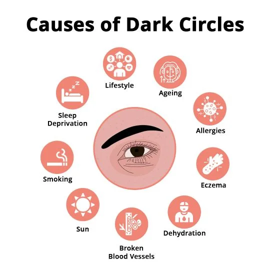 Causative Factors/ Triggers of Dark Circles Treatment In Hyderabad. Causes of Dark Circles: Lifestyle, Sleep Deprivation, Eczema and more.