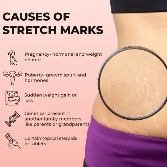 Causes  of Stretch Marks