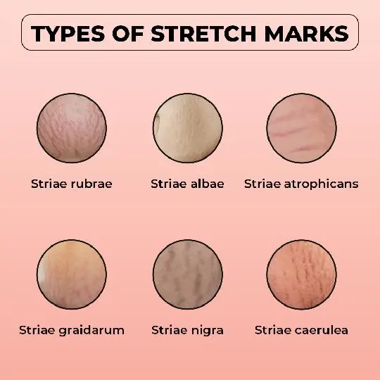 Types of Stretch Marks Pictures